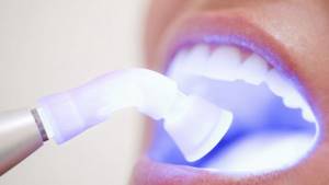 7 веществ, вредящих зубам, о которых вы даже не подозревали, Процедура отбеливания зубов
